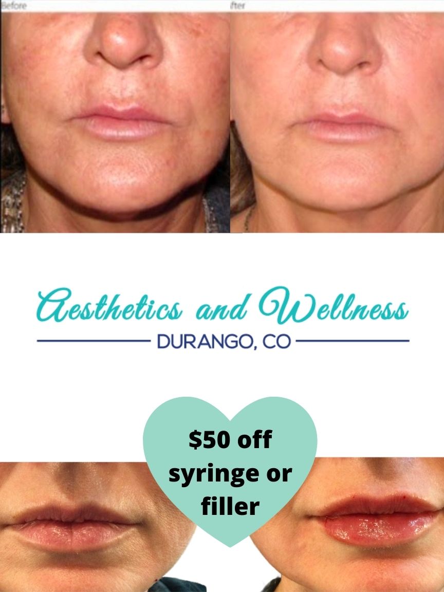 $50 off syringe or filler